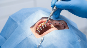 All-on-4 vs. All-on-6 Dental Implants: Which Full-Mouth Solution Is Right for You?